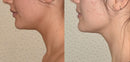 DrenaFace – Escova de Drenagem Linfática Facial